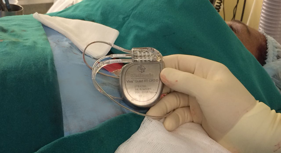  Витебские медики установили сердечный имплант
